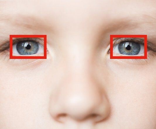 Le syndrome de la vision artificielle et les problèmes oculaires